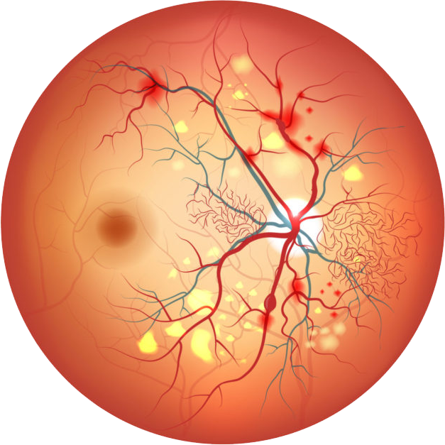 Retinopatía Diabética