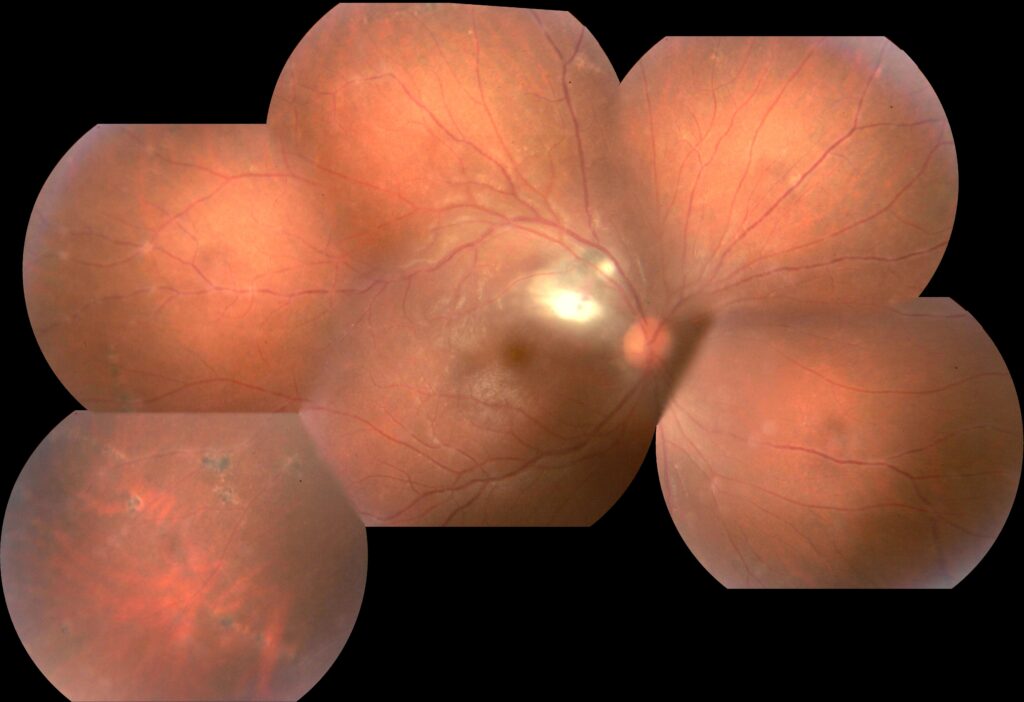 Toxoplasmosis ocular — fondo de ojo