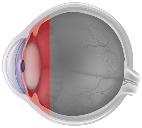 Uveítis Anterior