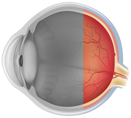 Uveítis Posterior