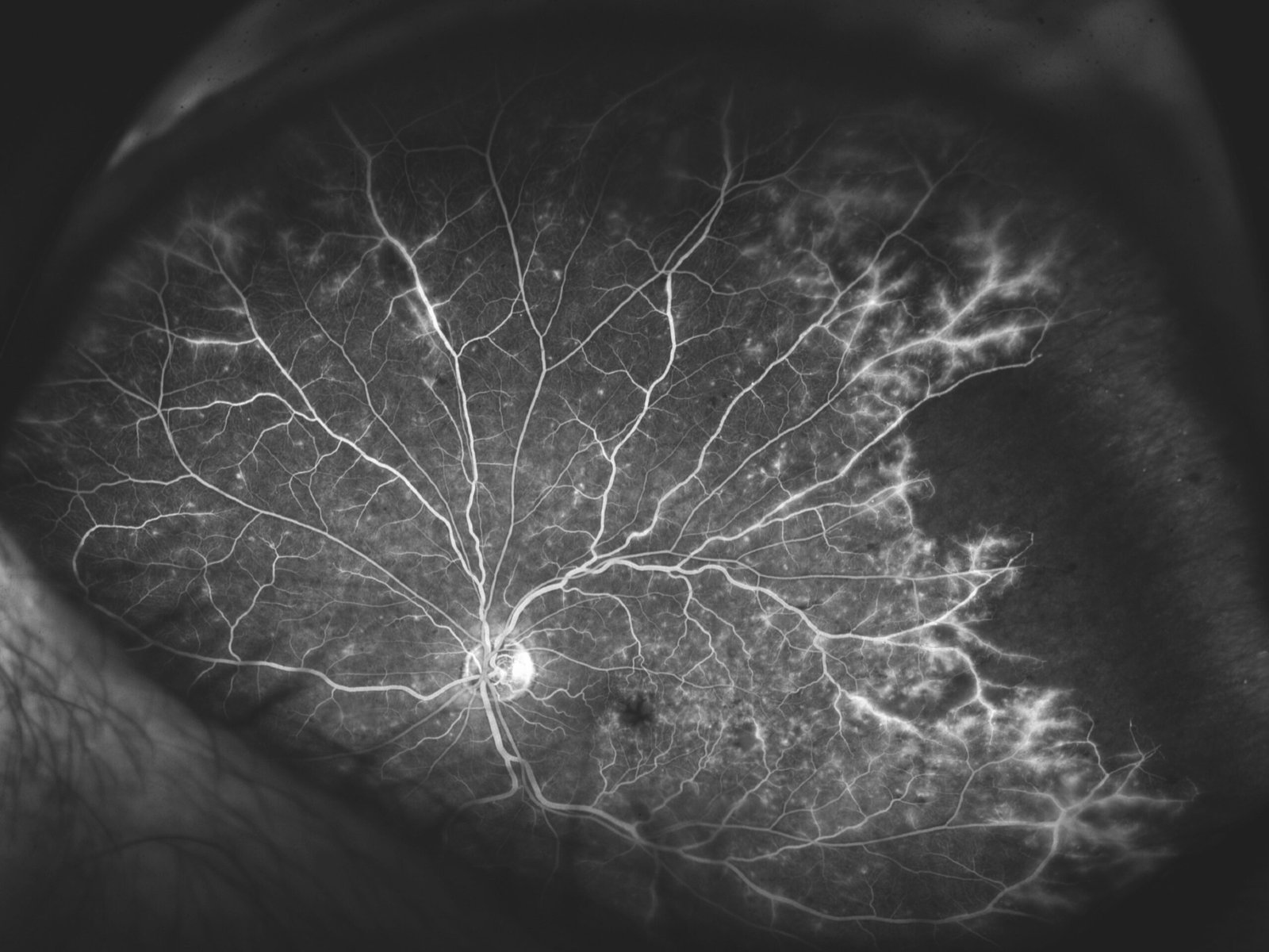 Vasculitis Retiniana